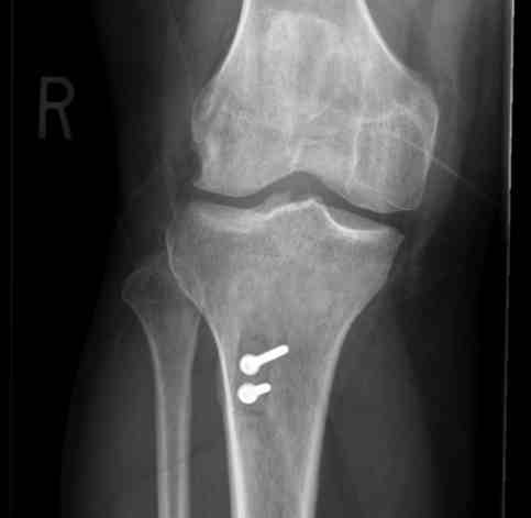 Chronic Patella Tendon Rupture Post OP AP